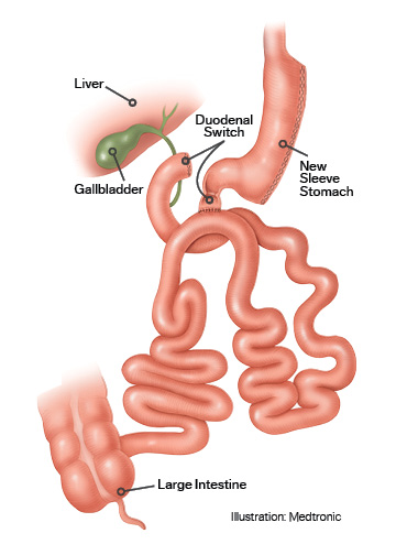 Duodenal switch