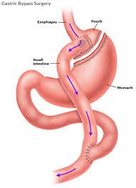 Gastric Bypass