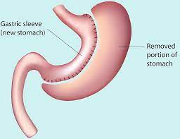 gastric sleeve