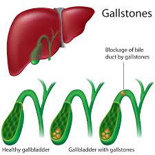 Gallbladder with stones