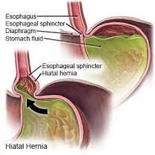 Hiatal Hernia diagram