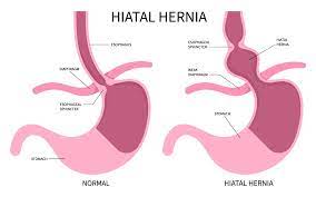 Hiatal Hernia diagram