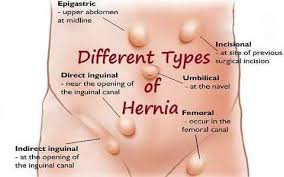 Types of Hernias