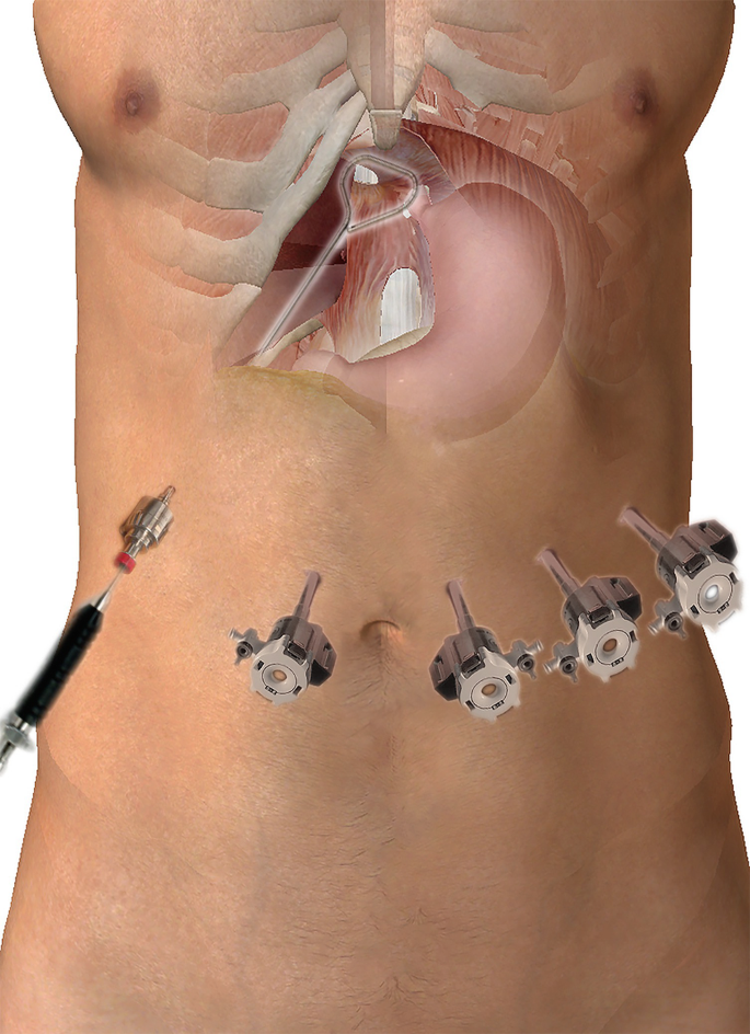 Hiatal Hernia Port Sites