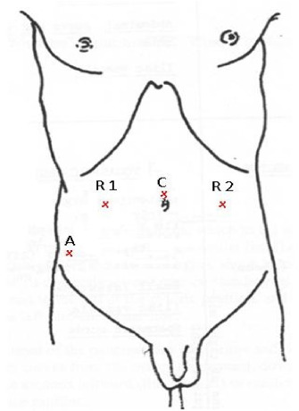 Inguinal hernia port placement