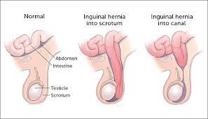 Inguinal hernia