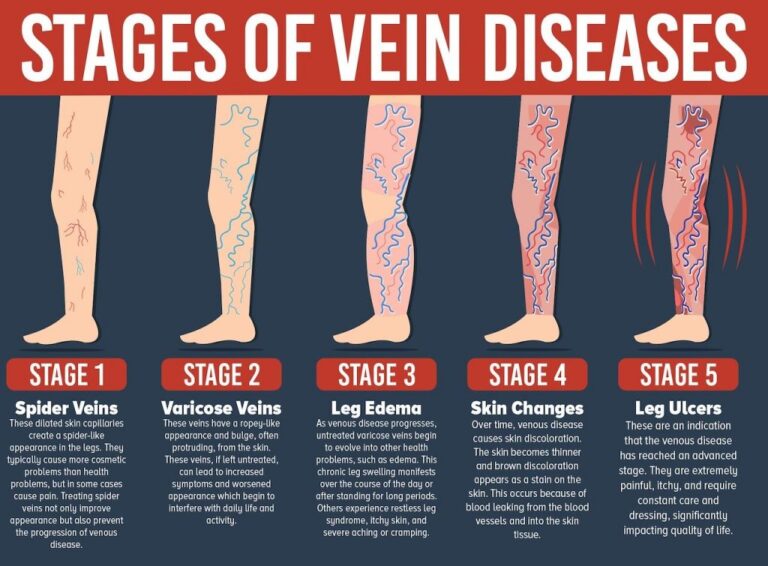 Varicose Vein Stages