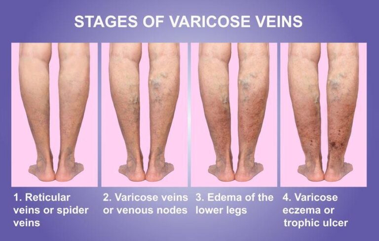 Varicose Vein Stages