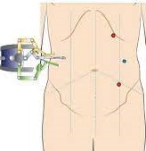 Ventral hernia port placement